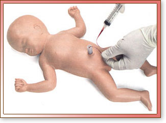 Bebé Umbi - cateterización umbilical neonatal