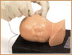 Bebé Ivy - acceso venoso periférico neonatal