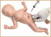 Bebé Umbi - cateterización umbilical neonatal